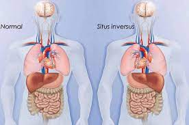 Situs inversus, the anomaly that causes the organs to be mirrored from  their normal positions